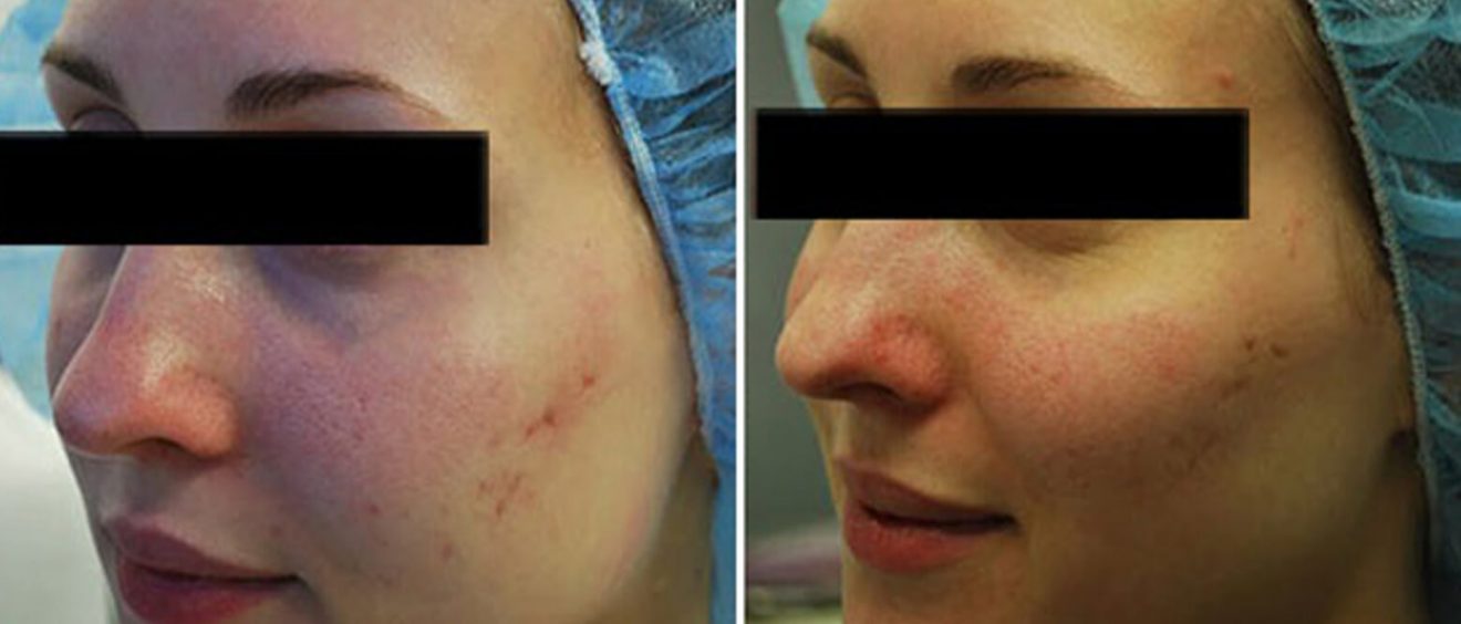 Dr-Conlon---Acne-Scars-Before-and-After