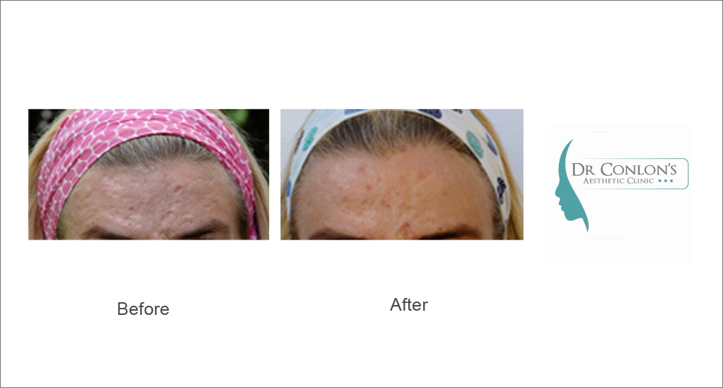 dr-conlon-acne-scarring